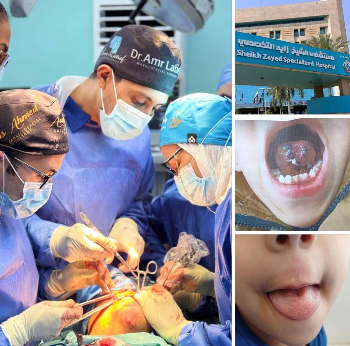 Egyptian medical team at Sheikh Zayed Hospital successfully performs delicate surgery for Palestinian child